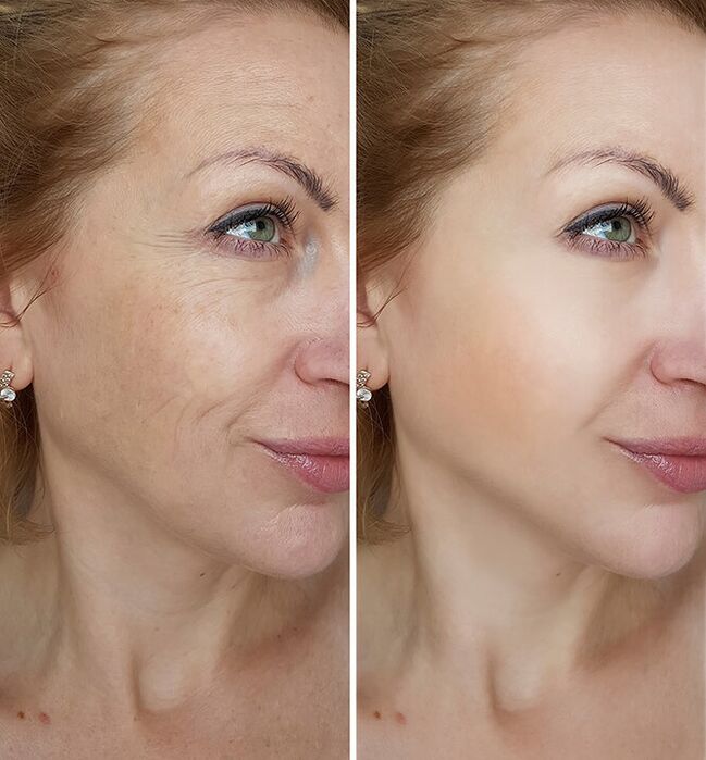 Как Yenki Derm подмлади Мария от Краков